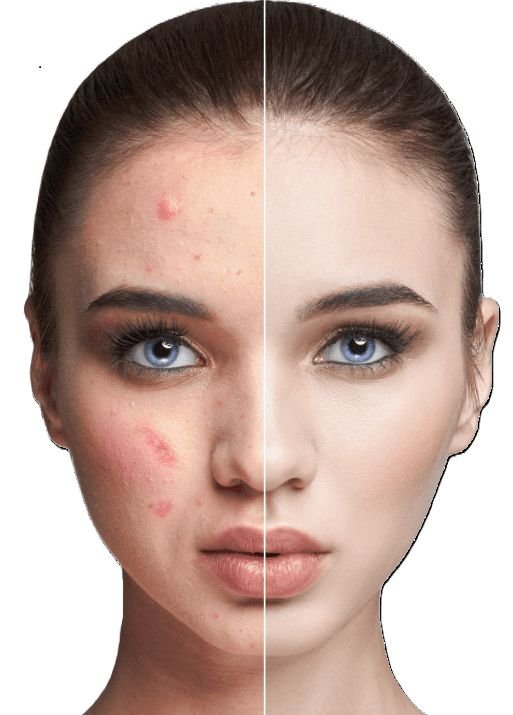 Vampire Facial in Vancouver