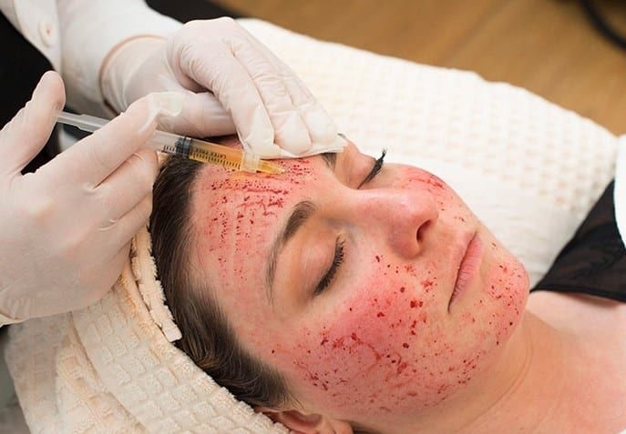 Vampire Facial in Vancouver