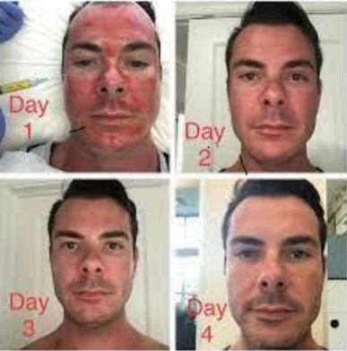 Radiofrequency Microneedling