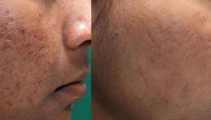 Acne Scar Laser in Vancouver